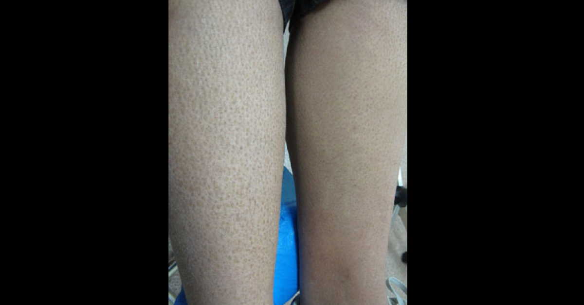 Dry and scaly lower limbs