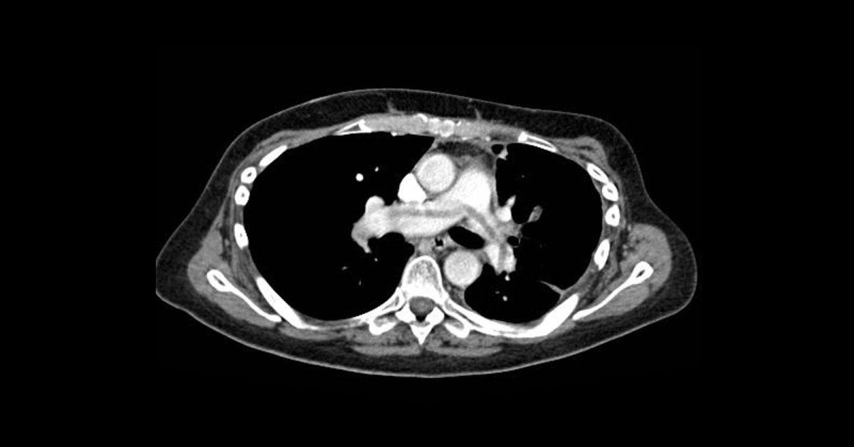Identify This Condition From CT Image