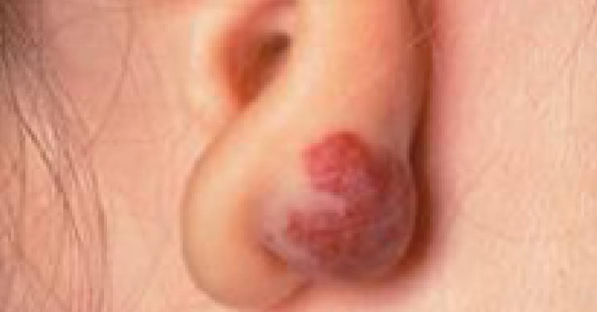 Diagnosis For Vascular Lesion