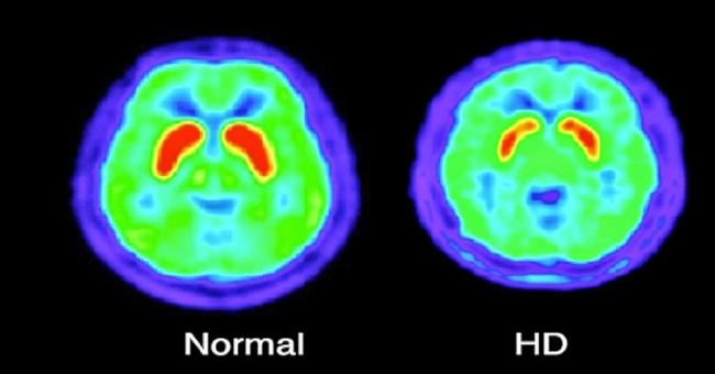 Chorea in Huntington Disease : American Academy of Neurology Guidelines
