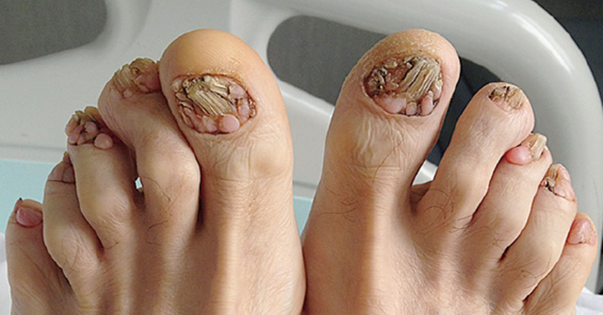 Identify This Cutaneous Condition