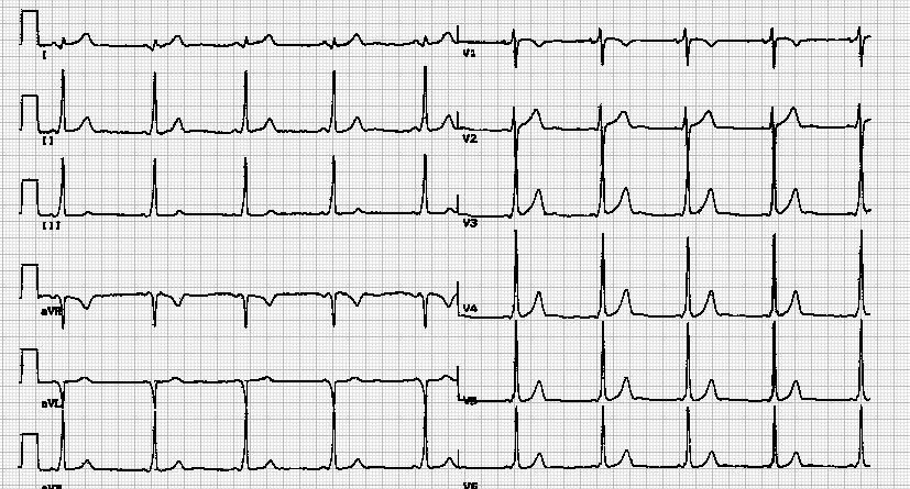 Identify The Abnormality From The ECG