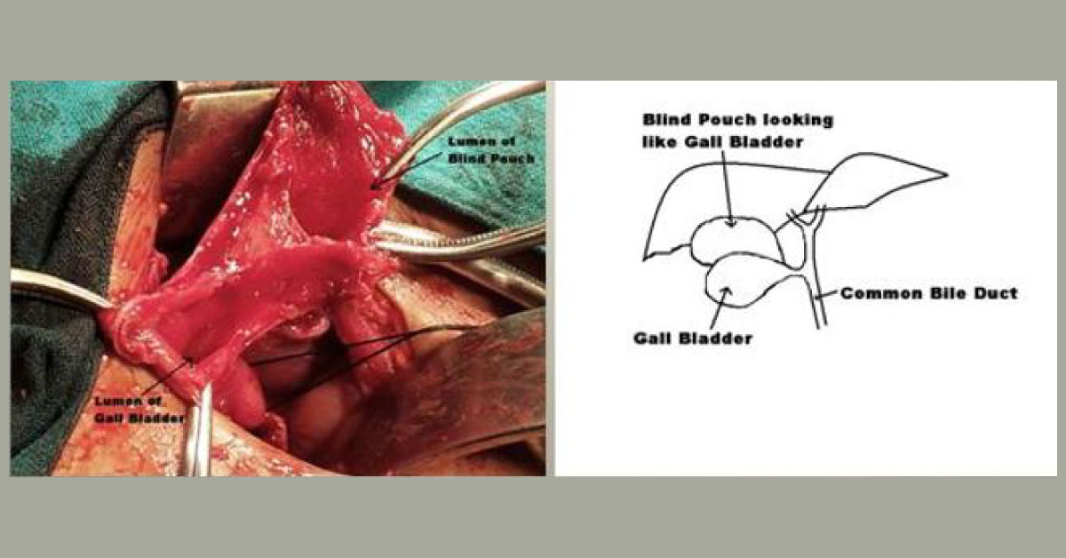 The Freak Shadow Gallbladder