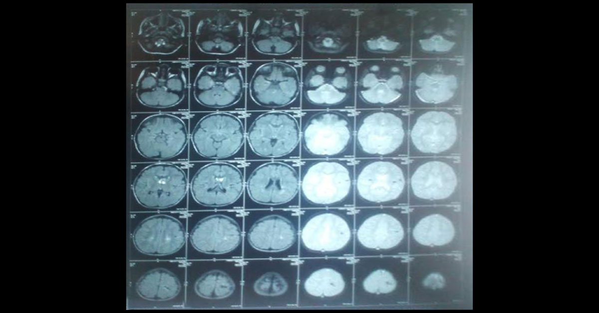 Boy With Recurrent Seizures With Abnormal MRI Brain
