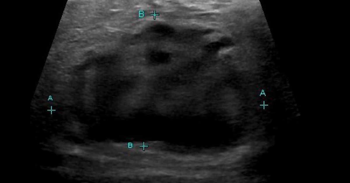 Identify The Type Of Lymphoma From Ultrasound
