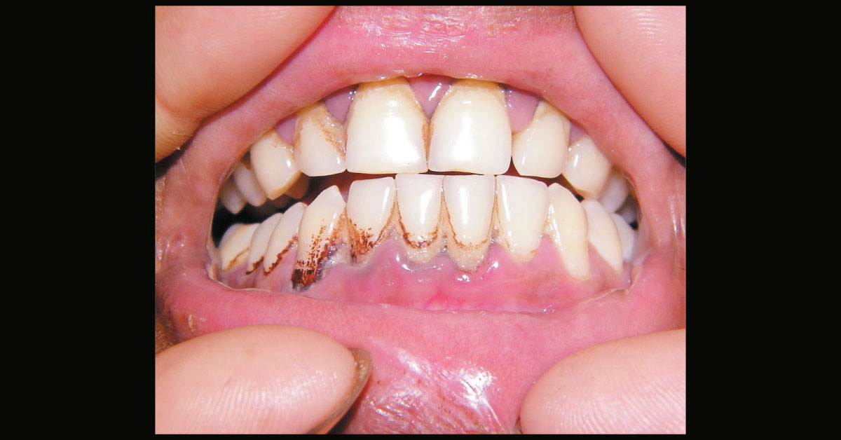 Identify The Cause Of This Oral Condition