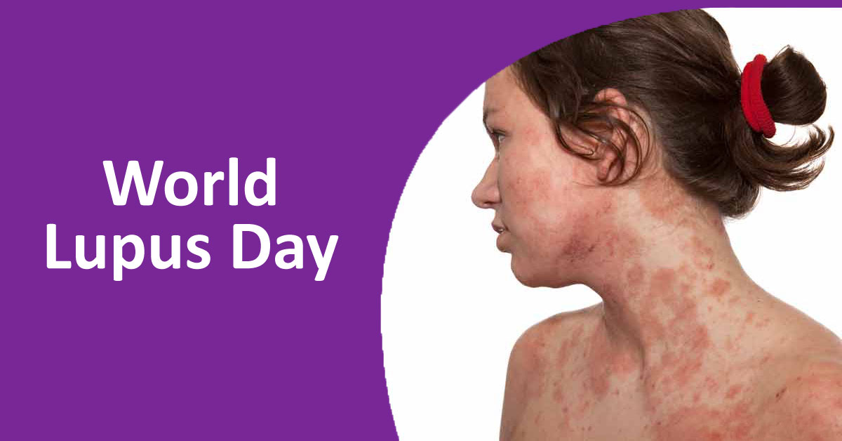 Systemic Lupus Erythematosus Management Guidelines