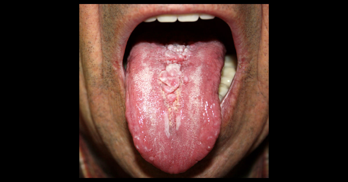 Identify The Oral Lesion