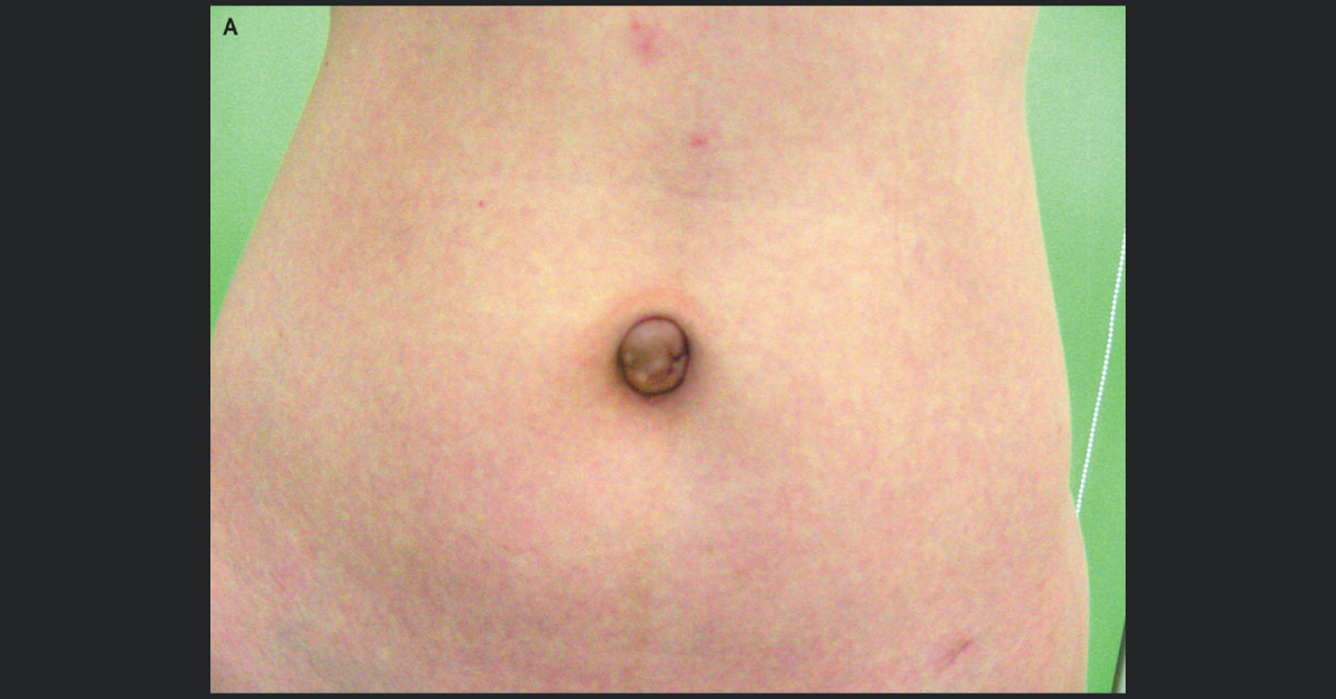 Cyclically Bleeding Cyst From Umbilicus