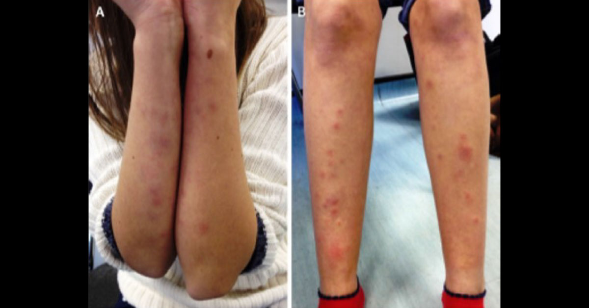 Diagnose The Rash On The Arms And Legs