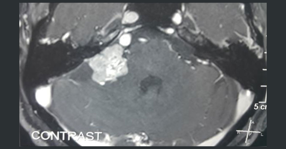CP Angle Tumor