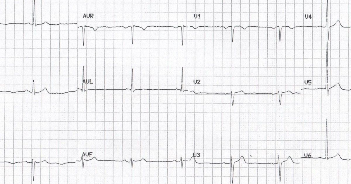 Spot The Abnormality From The Attached ECG