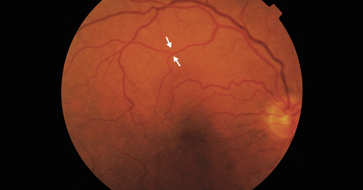 Blurred Vision In An Elderly Patient