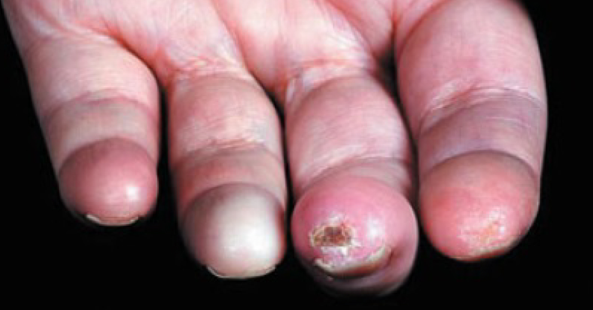 Tightening Of The Skin Over The Limbs