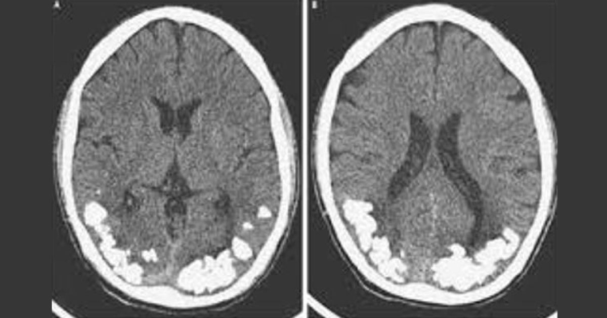 Focal Cerebral Calcification In Epilepsy