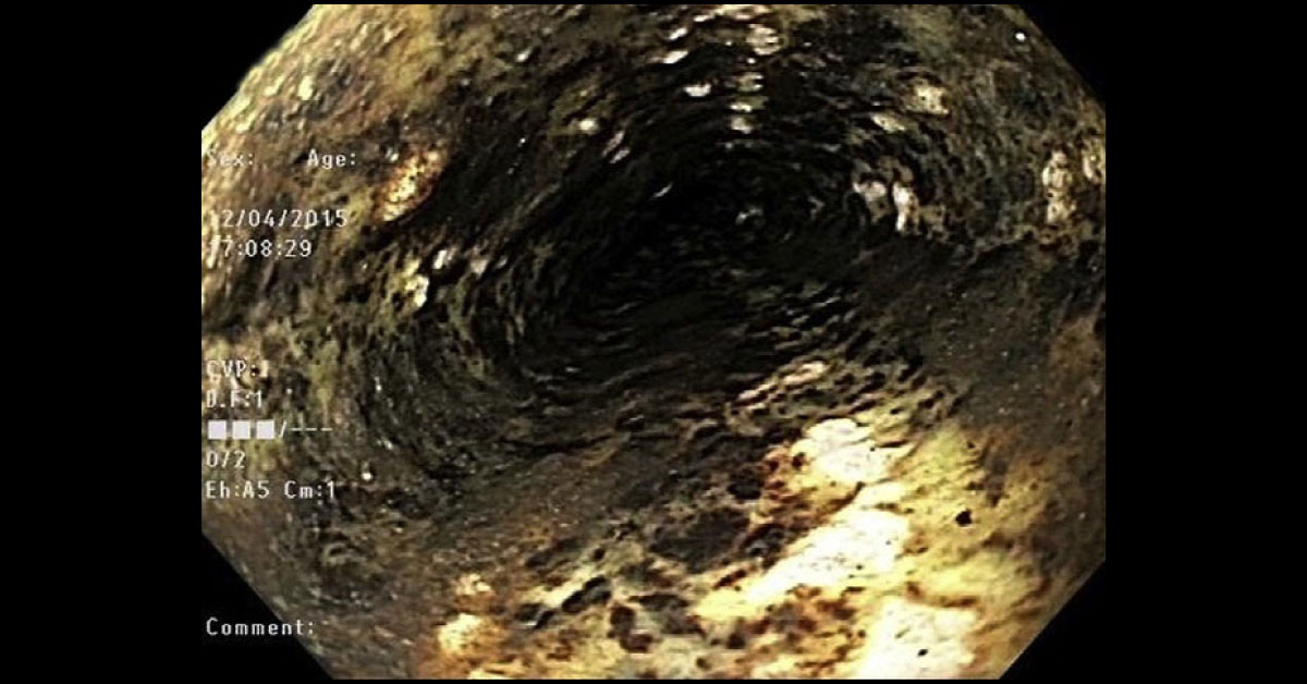 Identify The Cause Of Coffee Ground Emesis