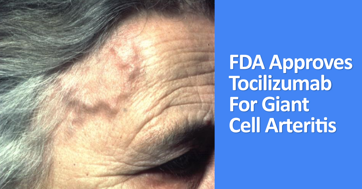 Tocilizumab, First FDA Approved Drug For Giant Cell Arteritis