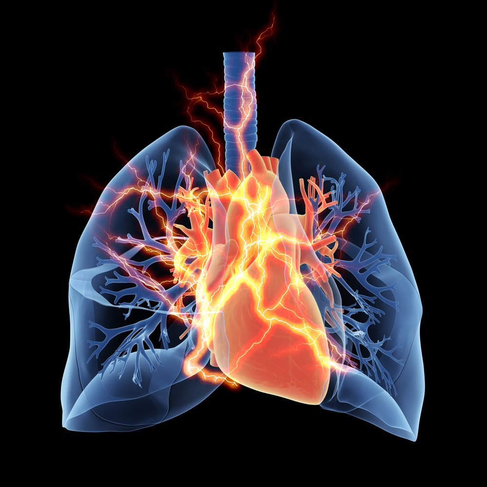 Primary Pulmonary Hypertension, A Need Of Better Awareness Among Physicians