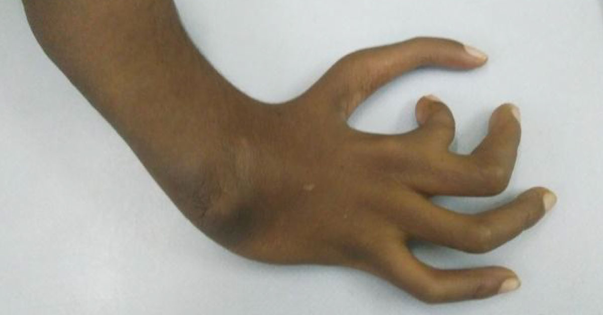 Congenital Hand Anomalies And VACTERL Or VATER