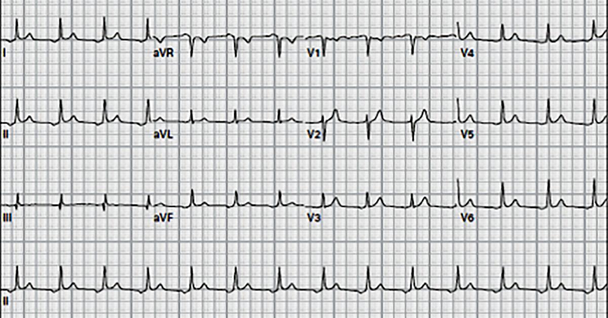 Interpret The ECG
