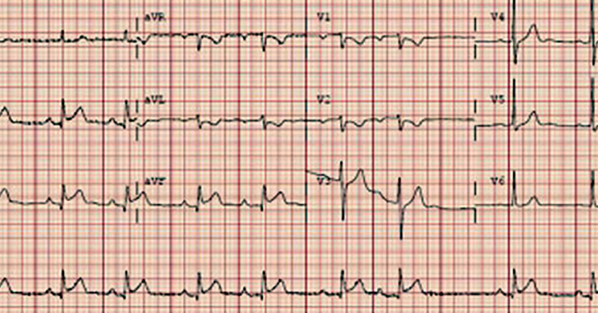 Chest Pain And Acute ST Elevations