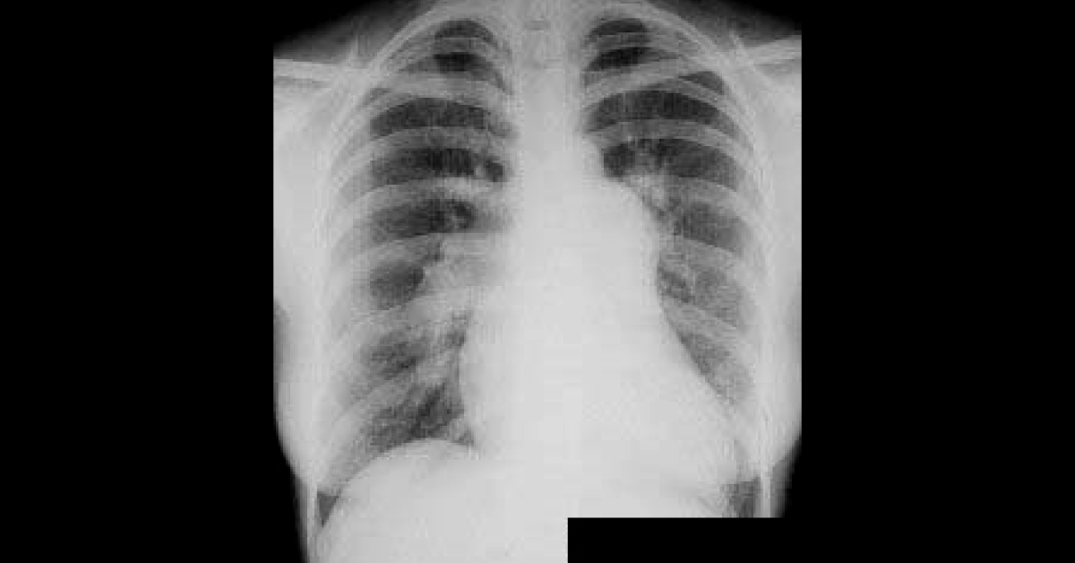 What This Radiograph Indicates