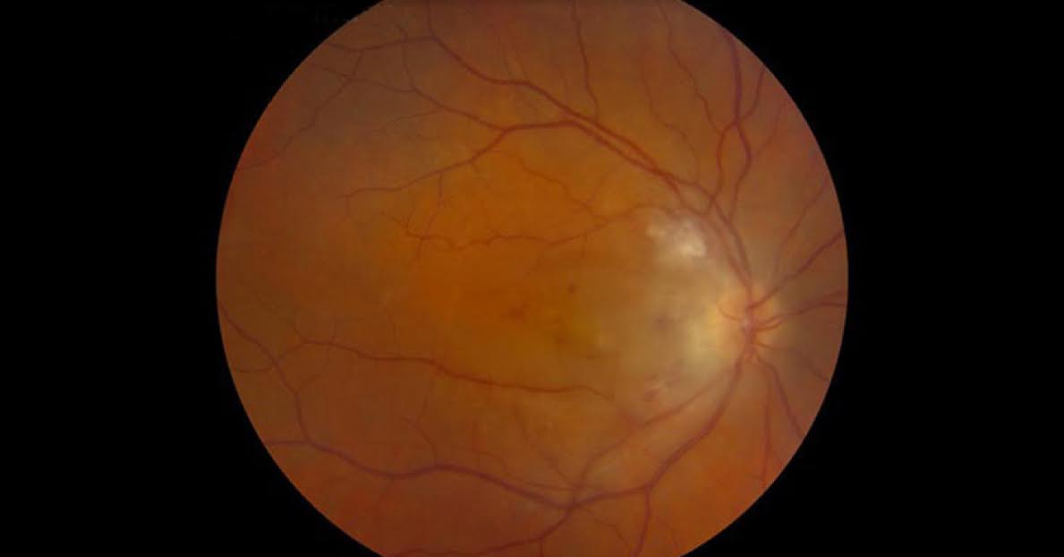 Spot the Ophthalmic Condition