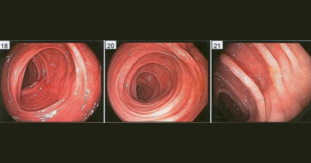 Colonoscopy