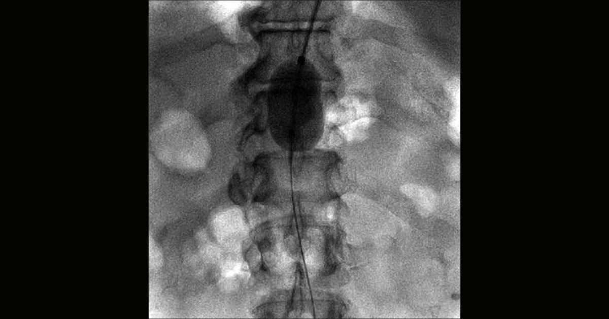Endoaortic Balloon Occlusion For Cardiac Surgery