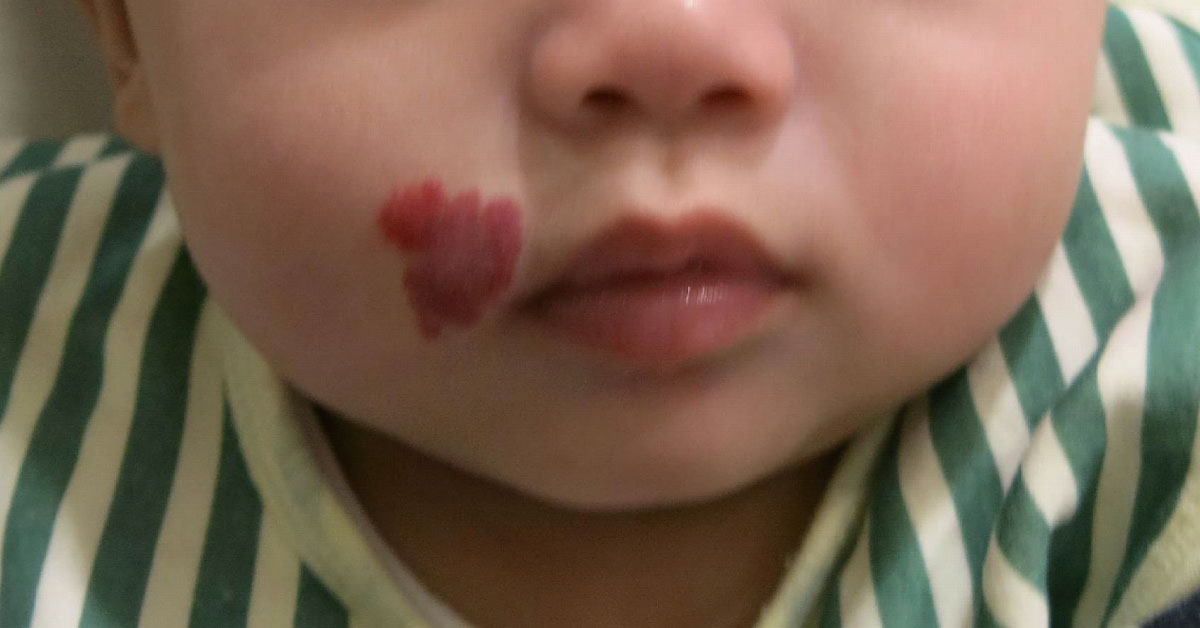 Infant With Red Nodule Over Right Face