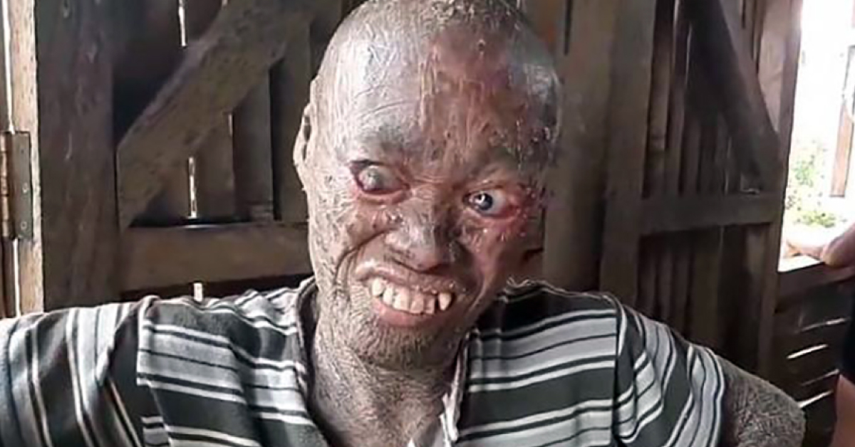 Man Branded As A Living Ghost Due To Rare Skin Disease