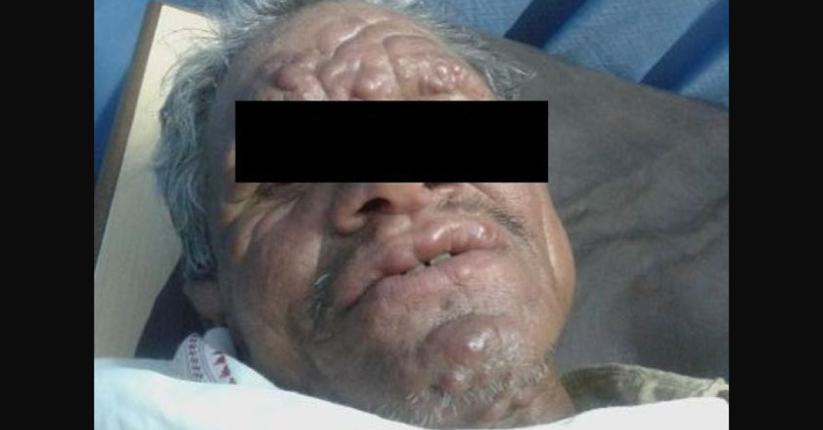 Diagnose Multiple Nodules On Body
