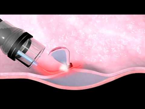 Barretts Oesophagus Treatment Using Photodynamic Therapy
