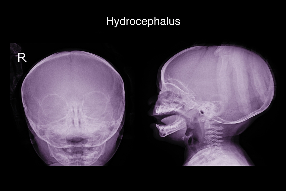 Hydrocephalus, An Overview
