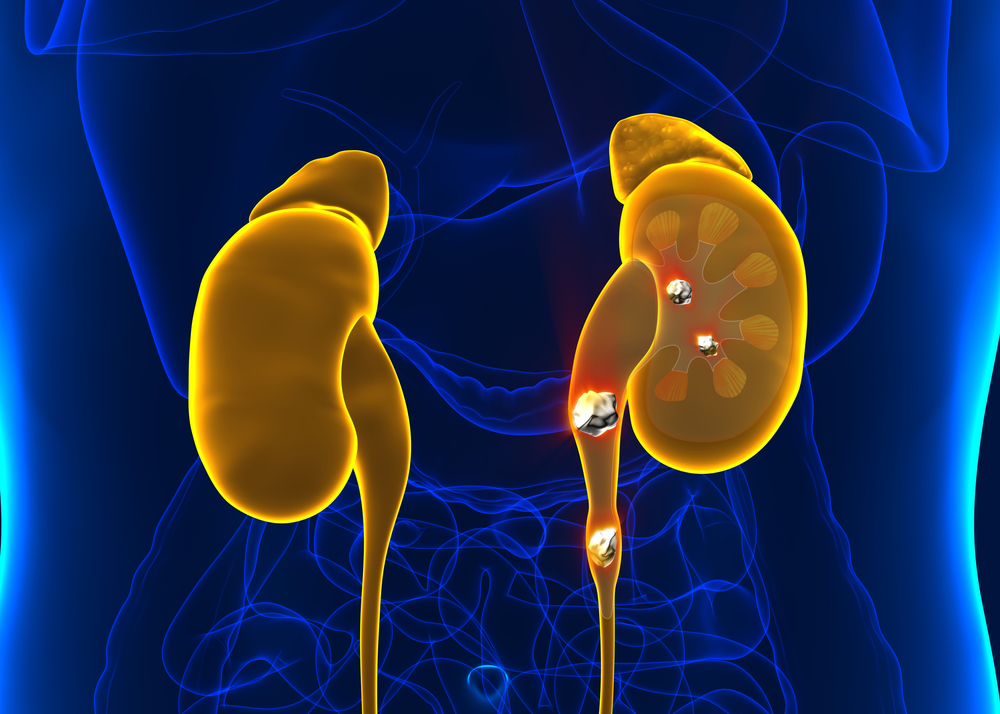 Calcium, Hard Water And Renal Stones Formation