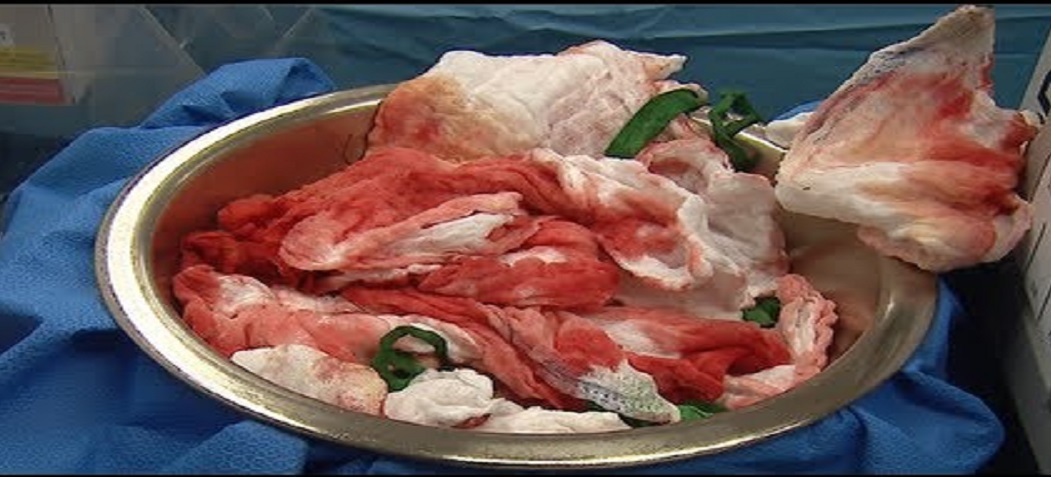 Should A Retained Surgical Mop Be Documented