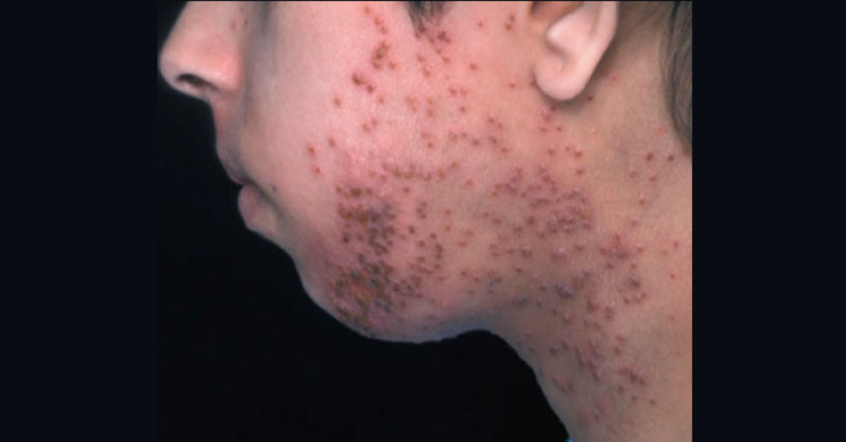 An Acute Monomorphic Eruption In A Systemically Unwell Atopic Child