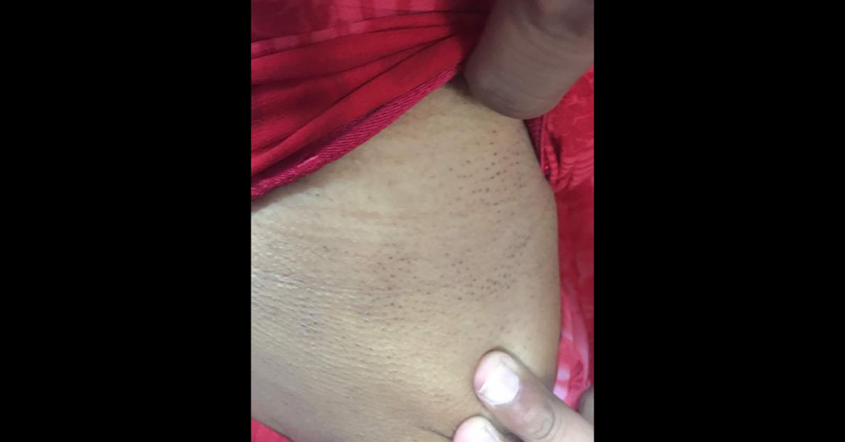 Describe This Dermal Condition