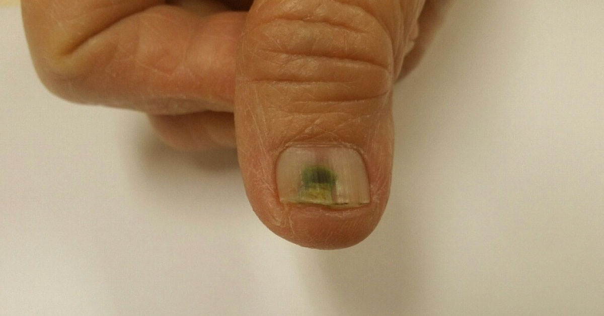 Diagnose The Greenish Nail