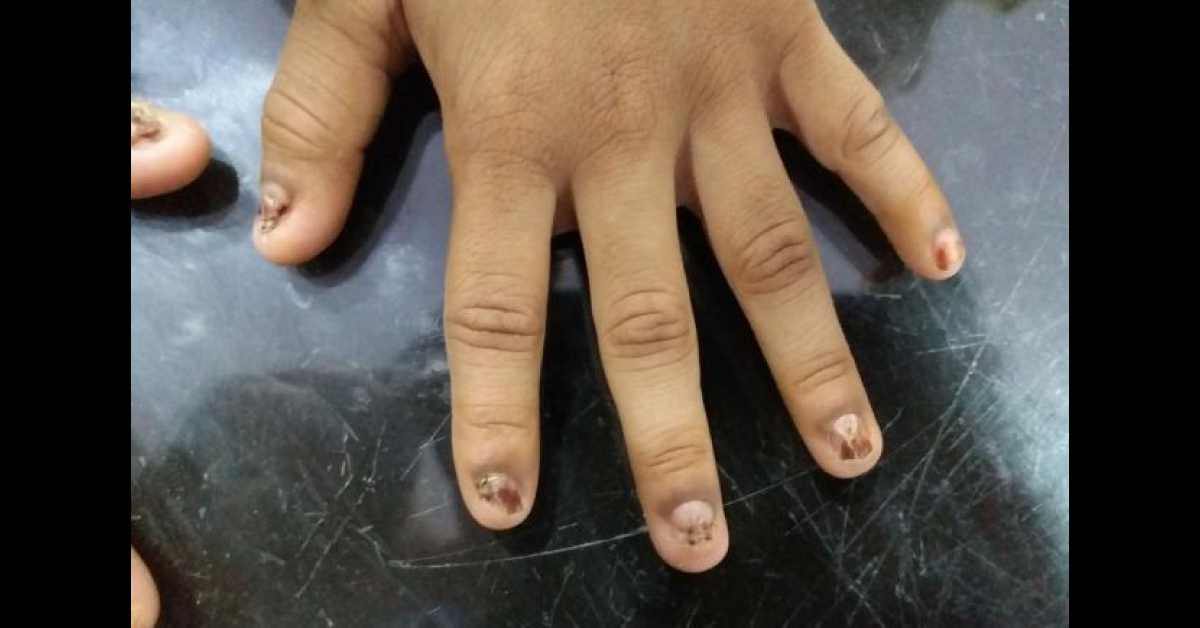 Identify The Nail Condition