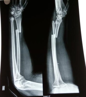 How To Treat The Distal Ulnar Fracture