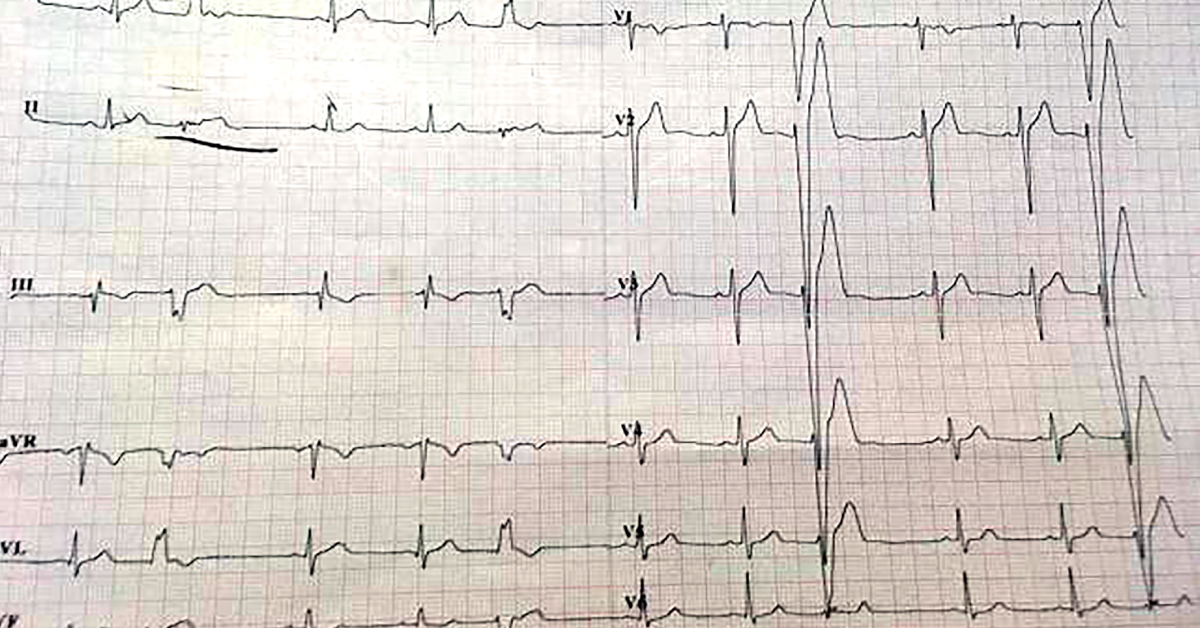 Rare Case Of Intermittent LBBB With 2:1 Presentation