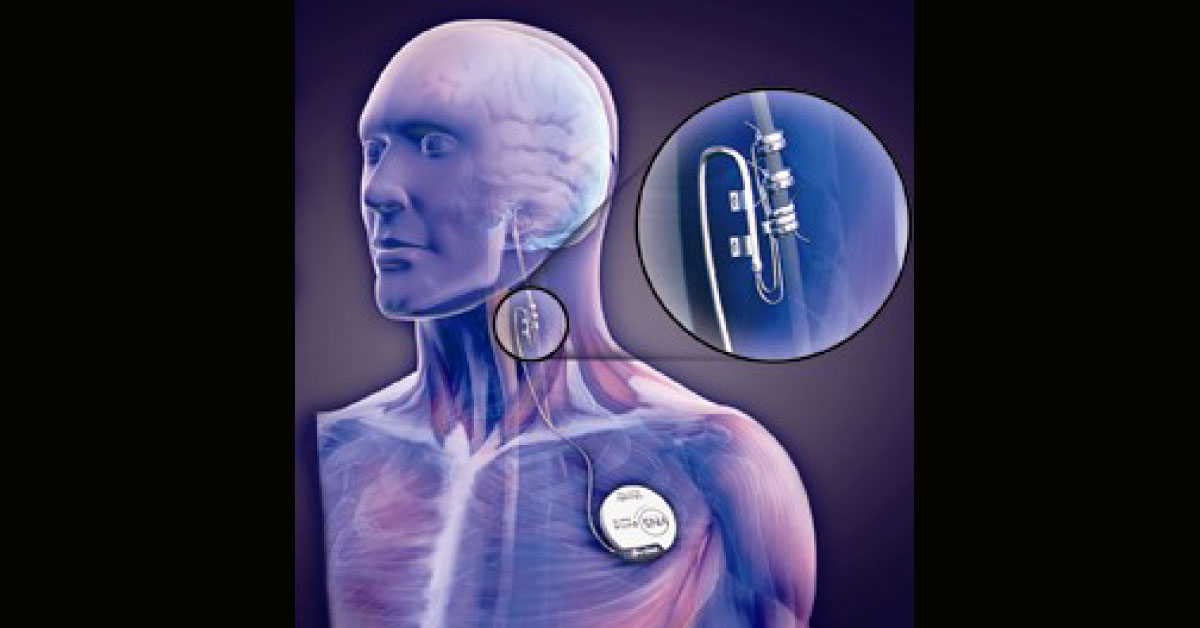 Epilepsy And Vagal Stimulation, An Old Practice Which Can Be Practically Applied