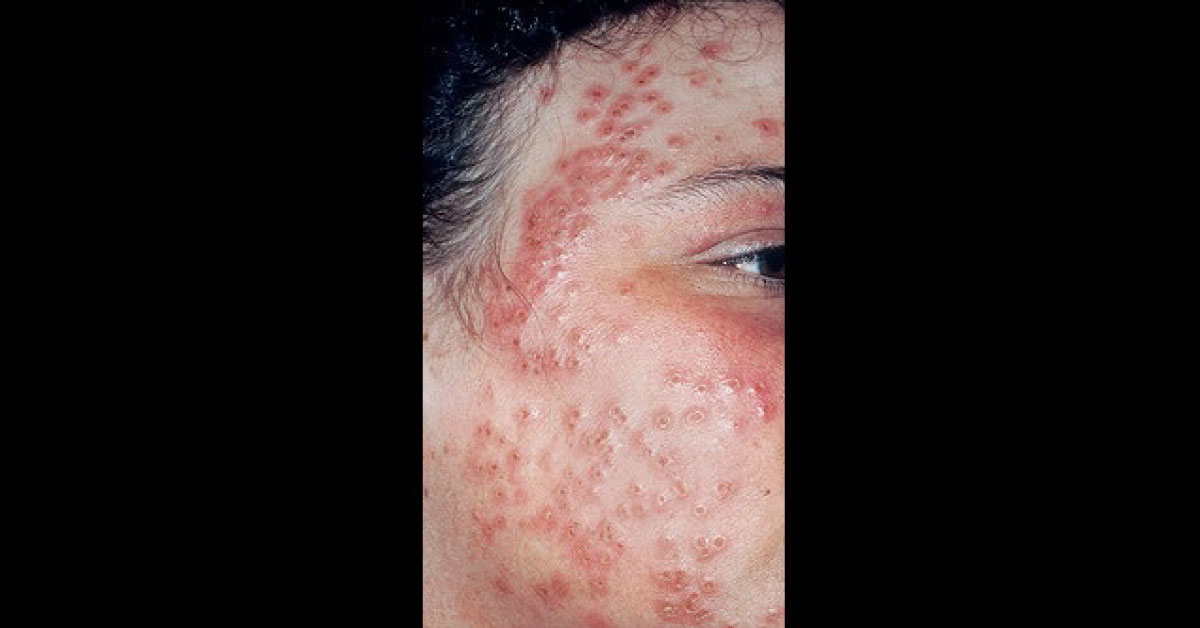 Spot The Derma Condition
