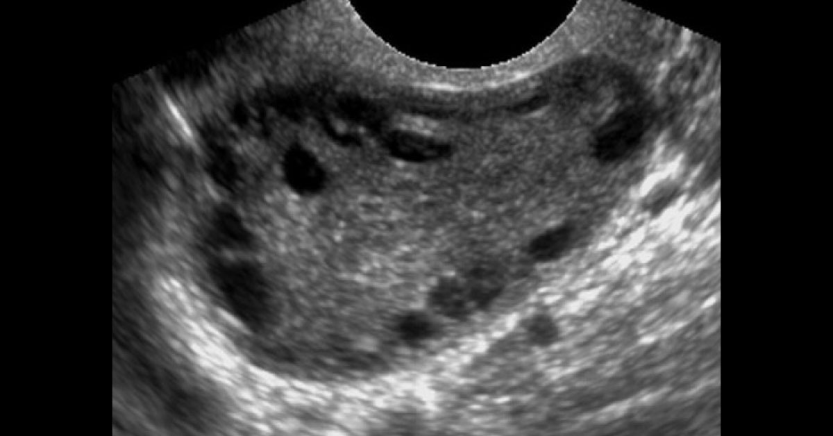 Identify The Radiological Findings From Image