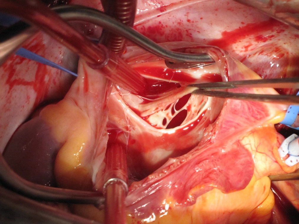 Atrial Septal Defect Treatment using Endovascular Closure