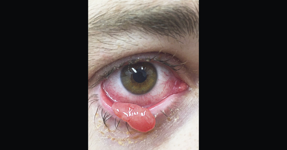Protrusion From The Eyelid