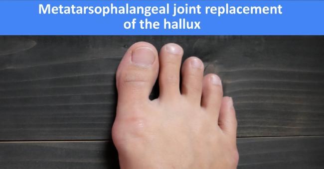 Metatarsophalangeal Joint Replacement Of The Hallux