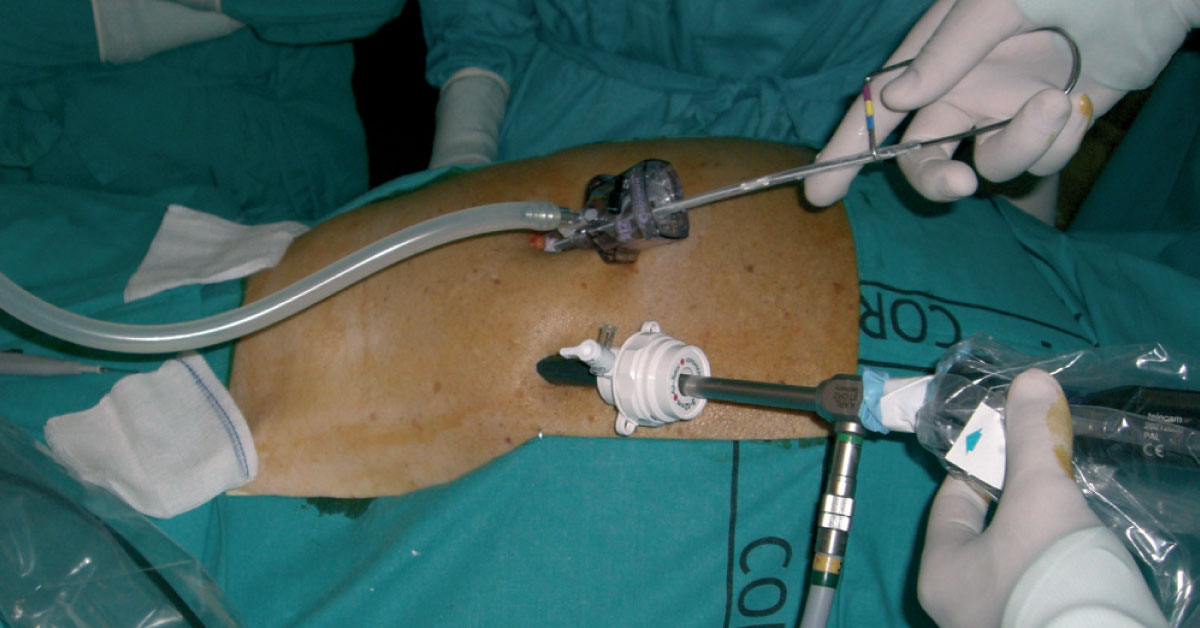 Laparoscopic Insertion Of Peritoneal Dialysis Catheter