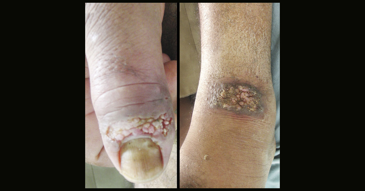 Ulcerated Paronychia In A Man